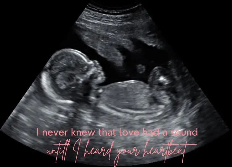 ultrasound picture of a baby